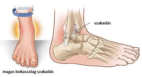 different types of ankle sprain different types of ankle sprain